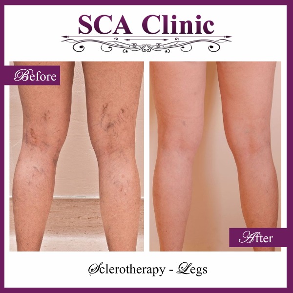 Sclerotherapy - Legs